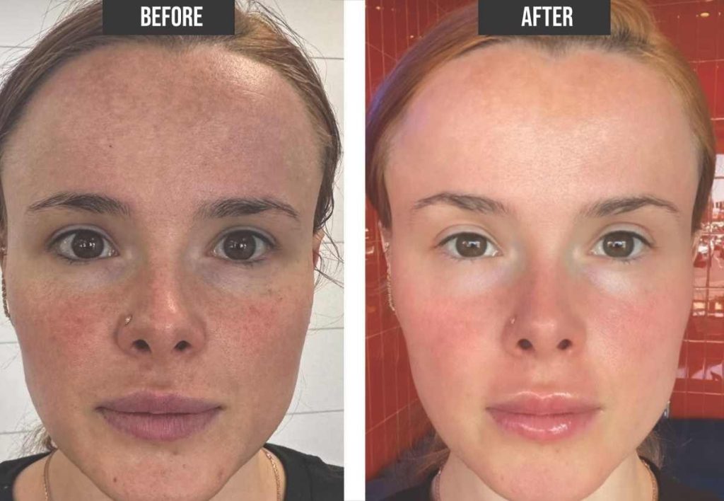 Side-by-side plasma fibroblast before and after image showing skin tightening and wrinkle reduction on eyes and jawline