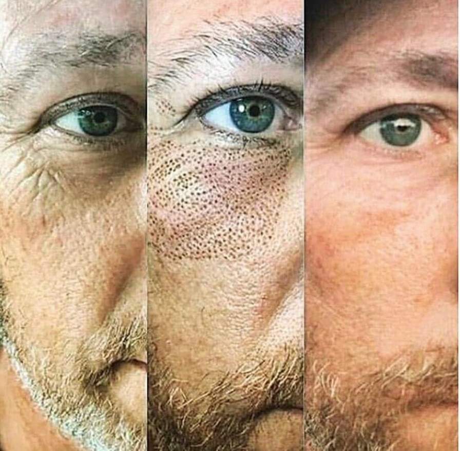 Plasma fibroblast before and after showing reduced under-eye bags and firmer lower eyelids after one session