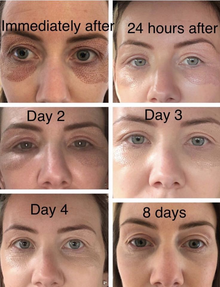 Plasma fibroblast healing timeline showing crusting, flaking, and new skin formation from day 1 to day 8