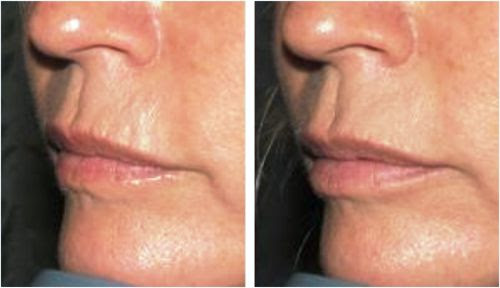 Plasma fibroblast before and after image showing improvement of lip lines and wrinkles above the mouth