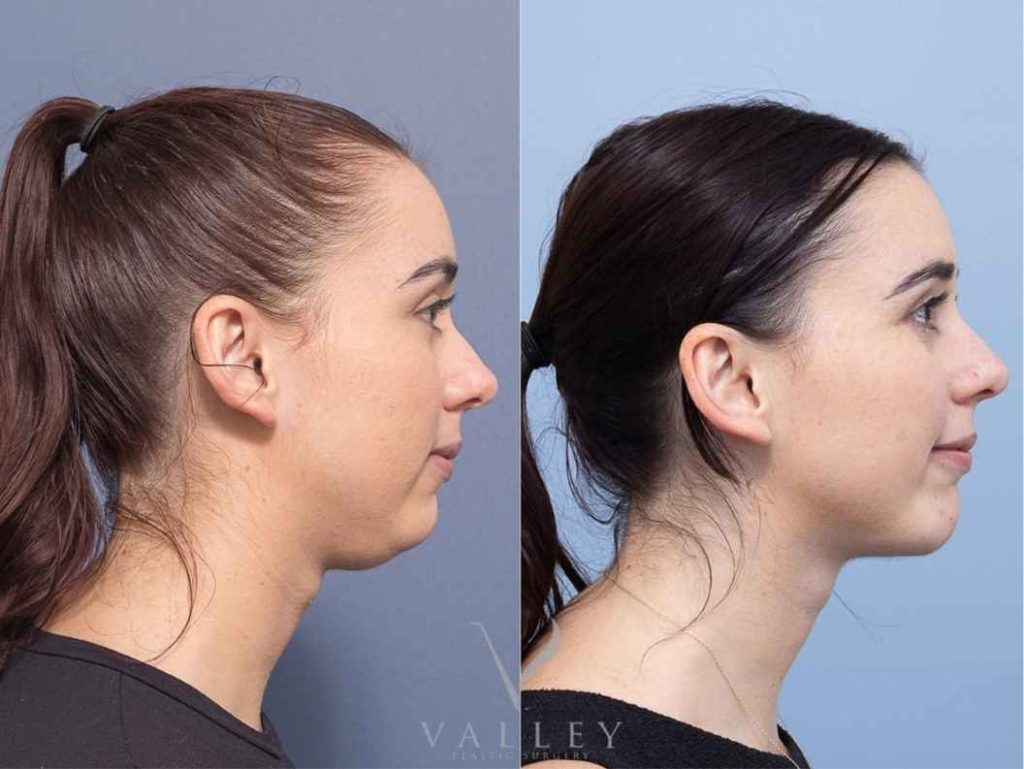 Plasma fibroblast before and after image of neck and jawline showing visible skin tightening and reduced sagging