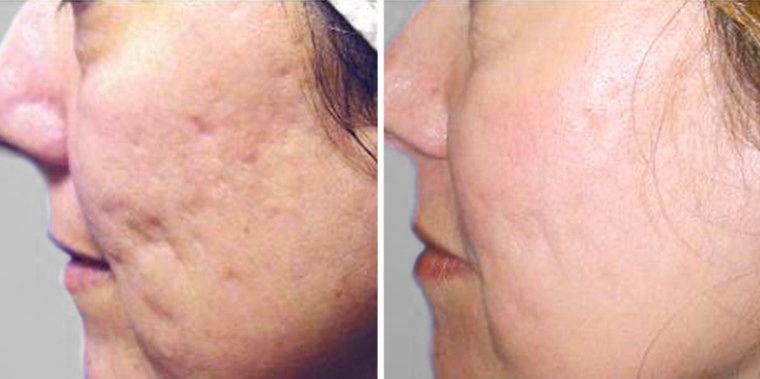 Before and after photo showing smoother skin and reduced appearance of scars after plasma fibroblast treatment