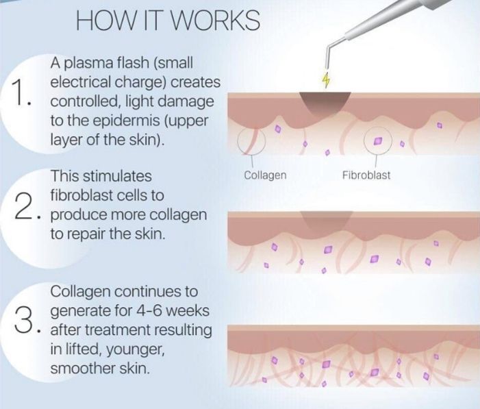 Diagram explaining how plasma fibroblast treatment works by using a plasma flash to stimulate collagen and fibroblast activity in the upper skin layer